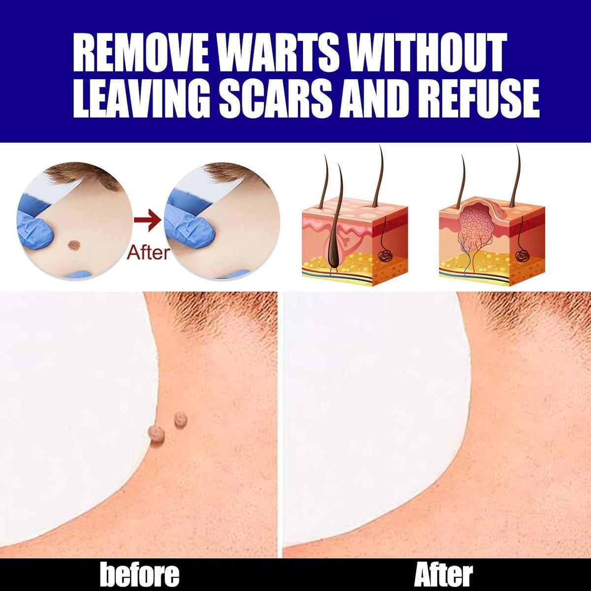 Warts Remover ointment